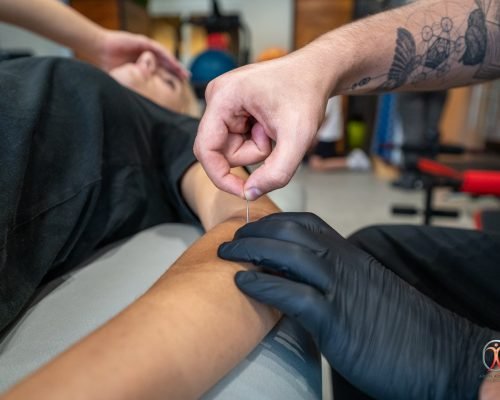 DRY NEEDLING pagina principala + servicii